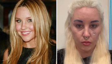 Amanda Bynes reveals she had bleph surgery to fix issues on her face