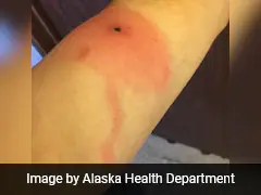 What Is Alaskapox, Viral Disease That Claimed A Life In US