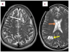 US Man Goes To Hospital With Migraines, Doctors Find Tapeworm In His Brain