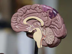 Stroke, Dementia Affect Over 3.4 Billion People Globally, Finds Lancet Study