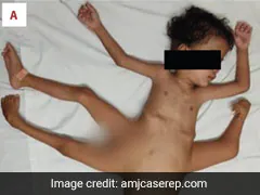 Extremely Rare Conjoined Twins Born In Indonesia Have 4 Arms, 3 Legs