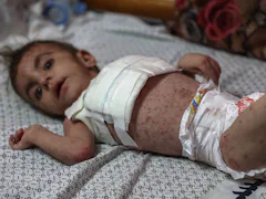 Dangerous Skin Diseases Spreading Among Malnourished Children In Gaza