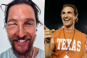 Matthew McConaughey’s eye swells shut after nasty bee sting