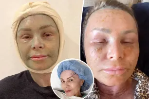 Tamra Judge shows major facial swelling after plastic surgery: ‘Progress isn’t always pretty’