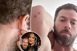 Artem Chigvintsev claims estranged wife Nikki Garcia was the abuser, shows off bloody scratches on arms, neck